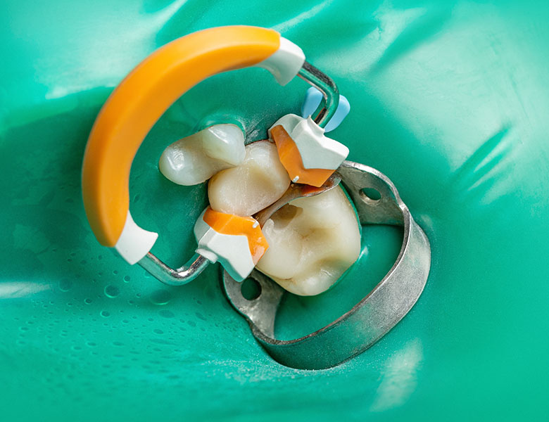 八千代緑が丘駅より徒歩1分の歯医者、公園都市プラザわかば歯科の根管治療