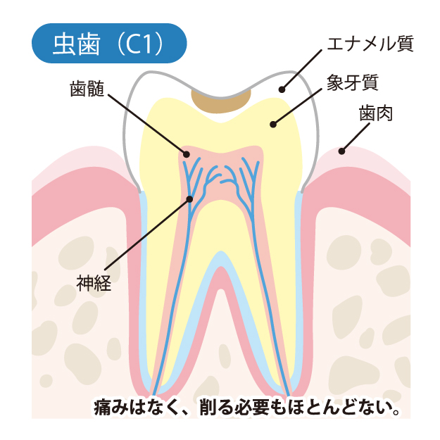  八千代緑が丘駅より徒歩1分の歯医者、公園都市プラザわかば歯科のなるべく削らず、歯を守る治療