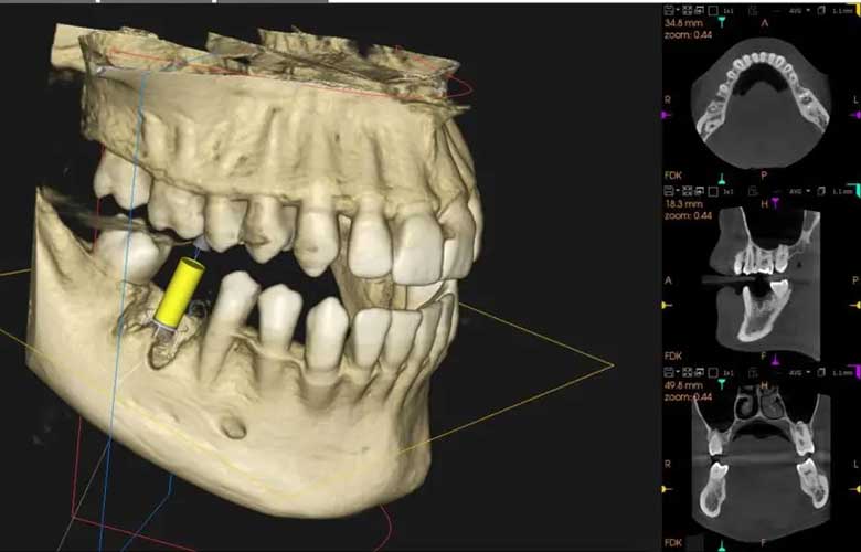 八千代緑が丘駅より徒歩1分の歯医者、公園都市プラザわかば歯科のなるべく削らず、歯を守る治療