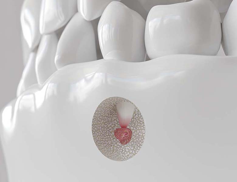 八千代緑が丘駅より徒歩1分の歯医者、公園都市プラザわかば歯科の根管治療