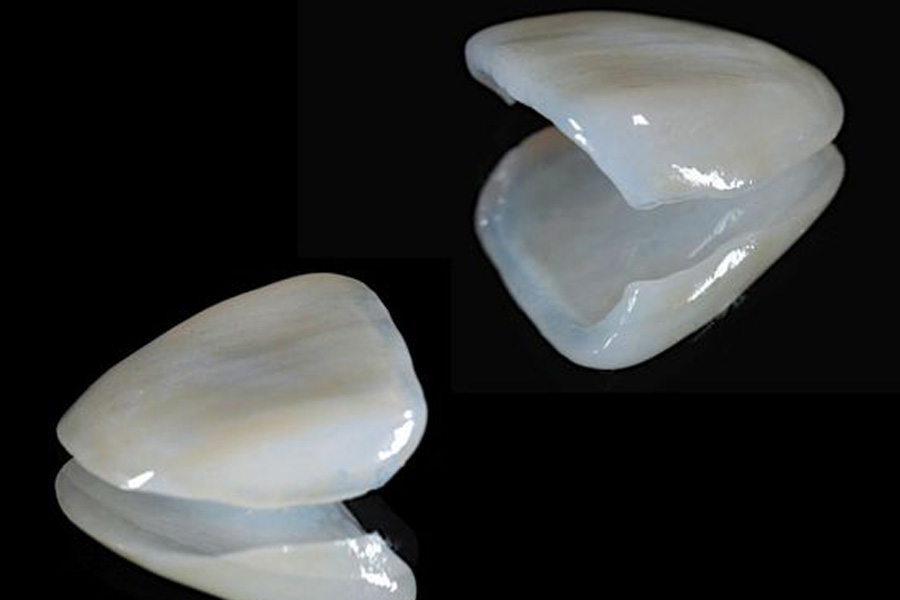 八千代緑が丘駅より徒歩1分の歯医者、公園都市プラザわかば歯科の審美歯科治療