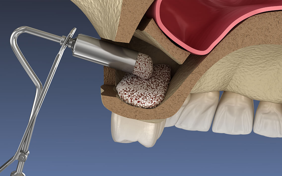 八千代緑が丘駅より徒歩1分の歯医者、公園都市プラザわかば歯科のインプラント治療