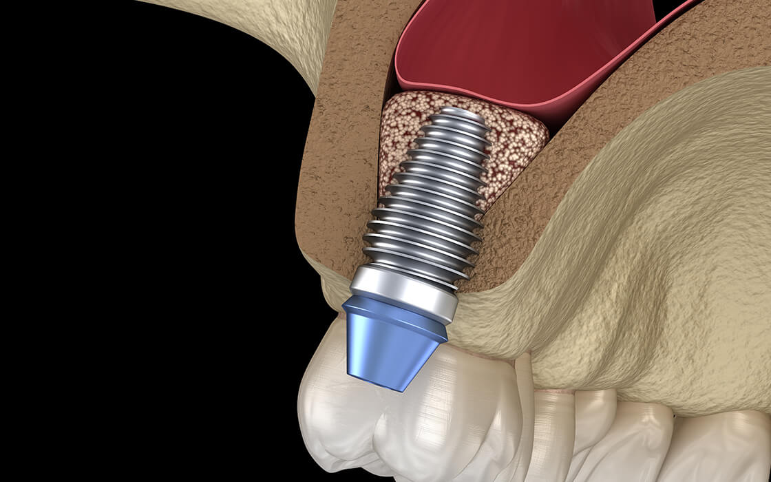 八千代緑が丘駅より徒歩1分の歯医者、公園都市プラザわかば歯科のインプラント治療
