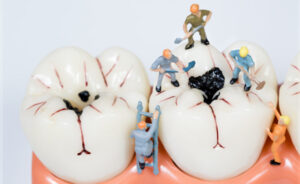 八千代市（八千代緑が丘）の歯医者、公園都市プラザわかば歯科で、「削らない虫歯治療」カリソルブって何？ ドックベストセメントとの違いについて解説