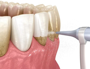 八千代市（八千代緑が丘）の歯医者、公園都市プラザわかば歯科で、エアフローって何？歯石は取れる？今までのクリーニングとの違いについて解説