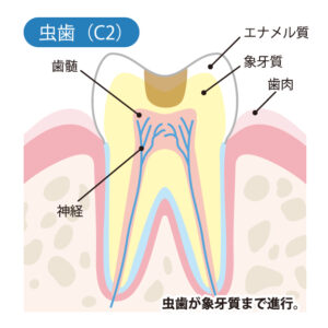 八千代市（八千代緑が丘）の歯医者、公園都市プラザわかば歯科で、「削らない虫歯治療」カリソルブって何？ ドックベストセメントとの違いについて解説