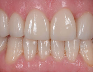 八千代市（八千代緑が丘）の歯医者、公園都市プラザわかば歯科で、エアフローって何？歯石は取れる？今までのクリーニングとの違いについて解説