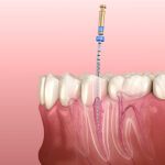 八千代市（八千代緑が丘）の歯医者、公園都市プラザわかば歯科で、なぜ歯の根の治療は長引くのか？半年以上終わらない「痛み」と「通院」を終わらせる精密根管治療について解説