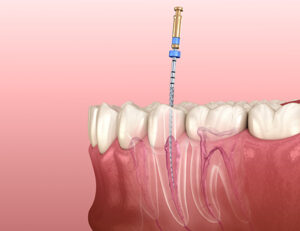 八千代市（八千代緑が丘）の歯医者、公園都市プラザわかば歯科で、なぜ歯の根の治療は長引くのか？半年以上終わらない「痛み」と「通院」を終わらせる精密根管治療について解説