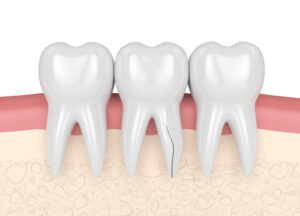 八千代市（八千代緑が丘）の歯医者、公園都市プラザわかば歯科で、なぜ歯の根の治療は長引くのか？半年以上終わらない「痛み」と「通院」を終わらせる精密根管治療について解説
