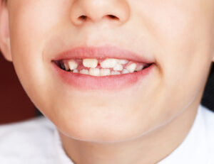 八千代市（八千代緑が丘）の歯医者、公園都市プラザわかば歯科で、むし歯になりやすい人、歯周病になりやすい人。その境界線と「自分に合った予防法」の正解について解説