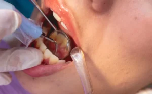 八千代市（八千代緑が丘）の歯医者、公園都市プラザわかば歯科で、なぜ歯の根の治療は長引くのか？半年以上終わらない「痛み」と「通院」を終わらせる精密根管治療について解説