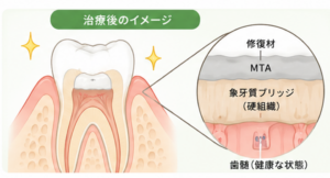 八千代緑が丘駅より徒歩1分の歯医者、公園都市プラザわかば歯科で、歯科治療で使う「ラバーダム」とは？目的やメリット・デメリットを解説